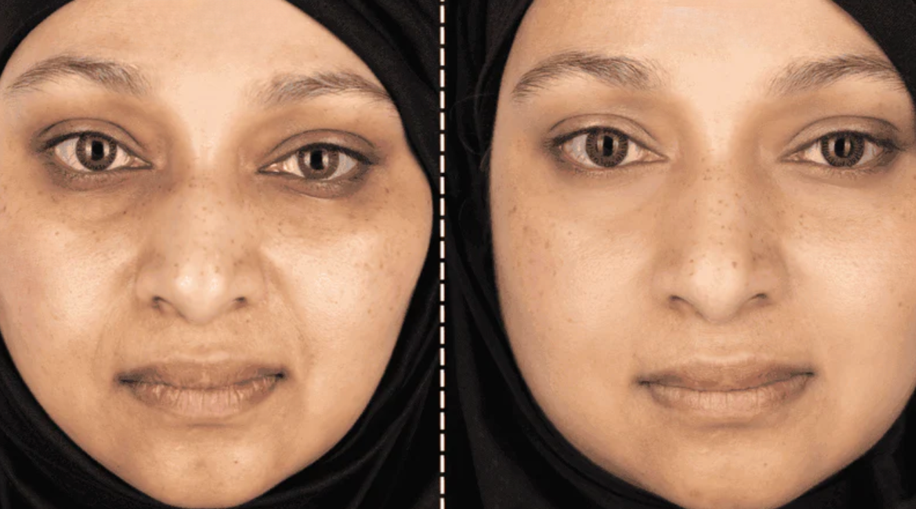 Results From Red Light Therapy Mask