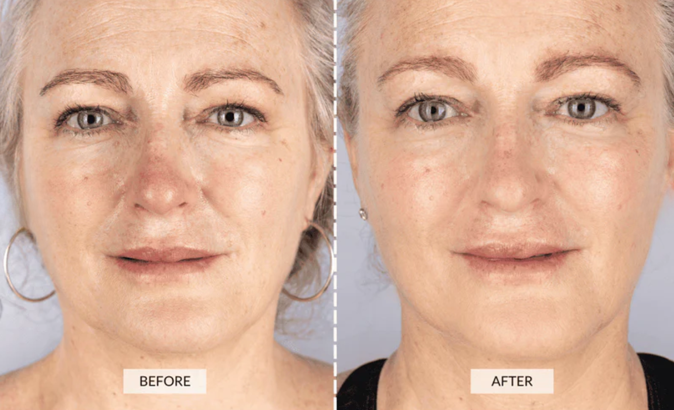 Results Less Wrinkles Shine Pro Luxe Red Light Therapy Mask FDA cleared