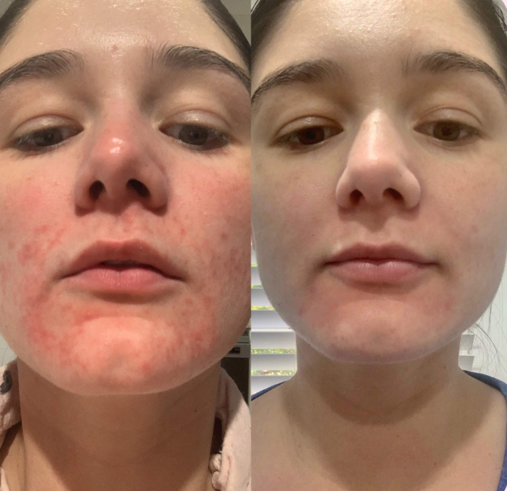 Results - From Shine Pro Luxe Red Light Therapy Mask Reduced Acne Clear Face