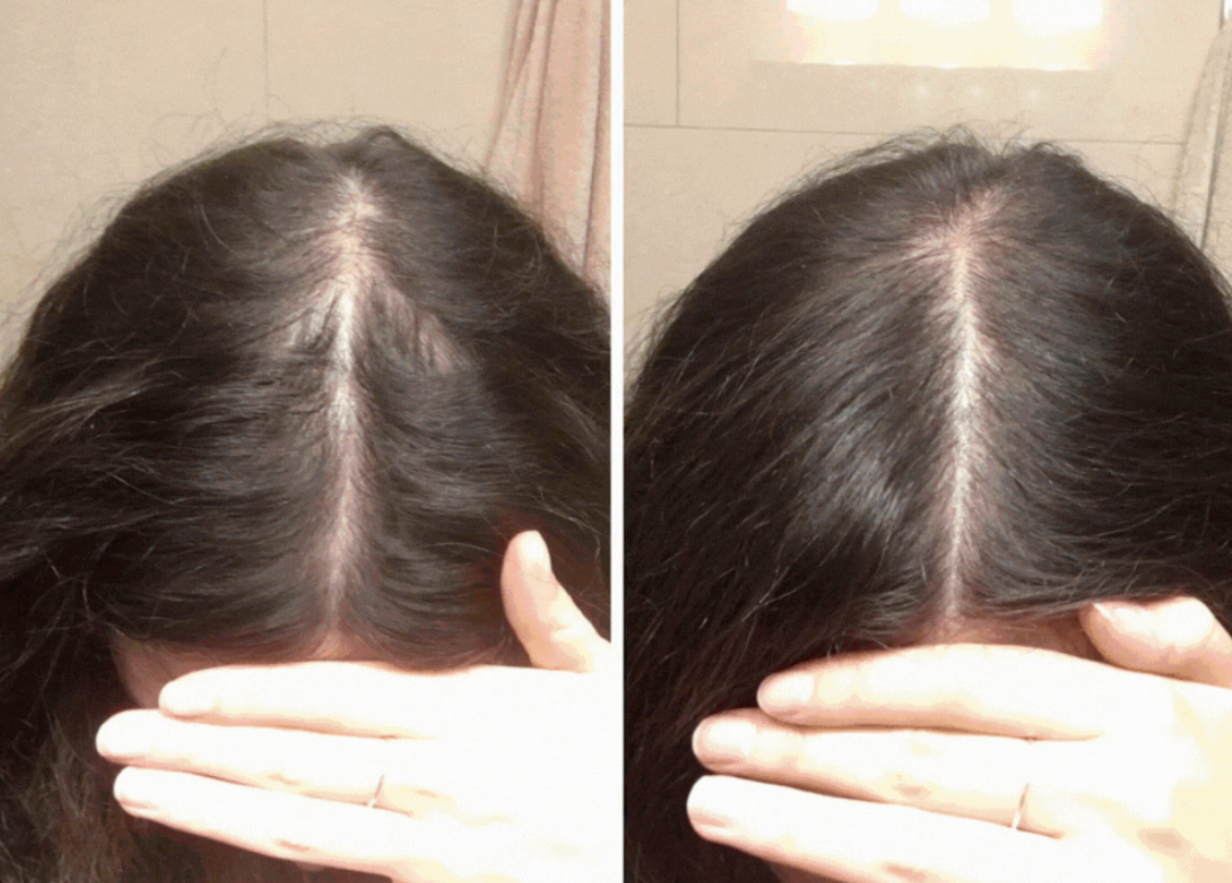 Results using shine pro luxe red light therapy LED hair Brush 